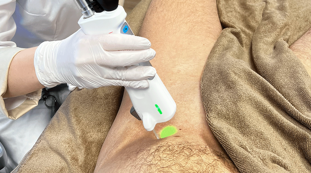 Pubic area laser on men, is it possible?