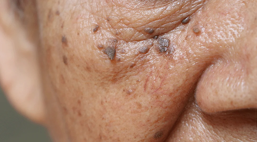 Elderwarts and skin bumps removal, can you do it yourself?