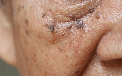Elderwarts and skin bumps removal, can you do it yourself?