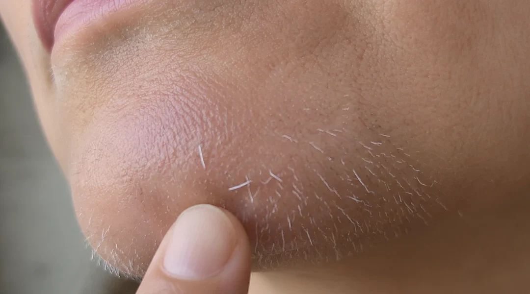 Waarom werkt laserontharing niet bij grijze en witte haren?