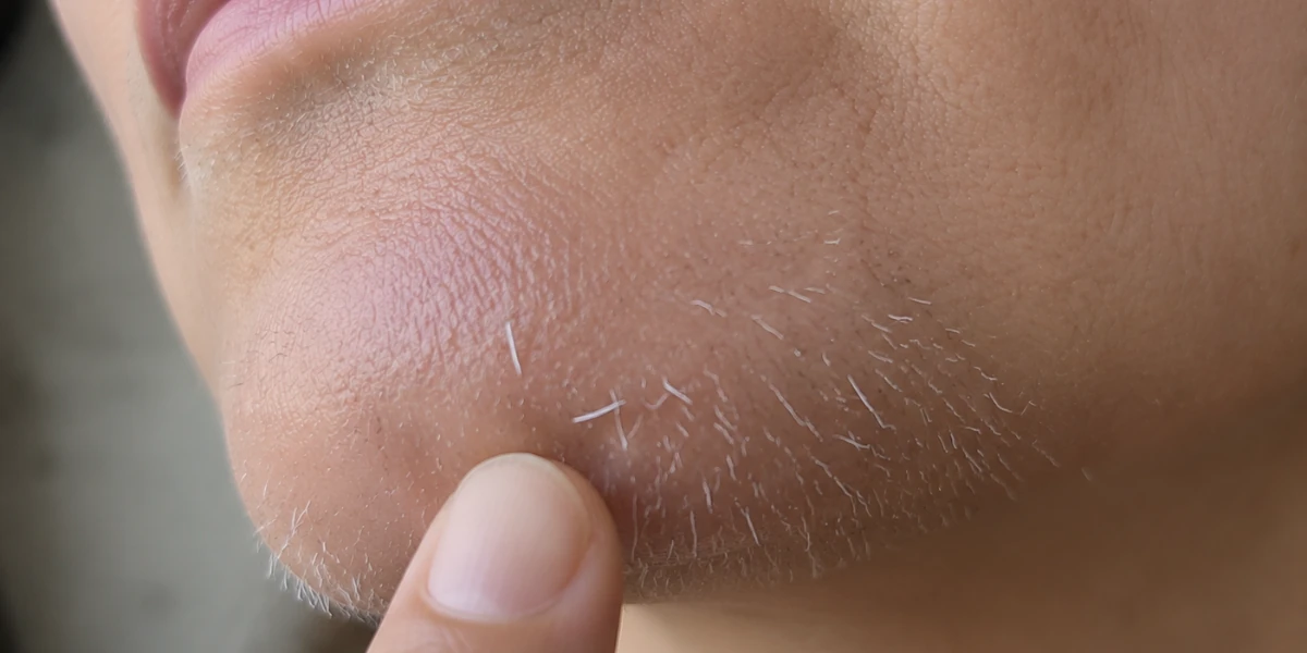 Huidtherapeut voor laserontharing