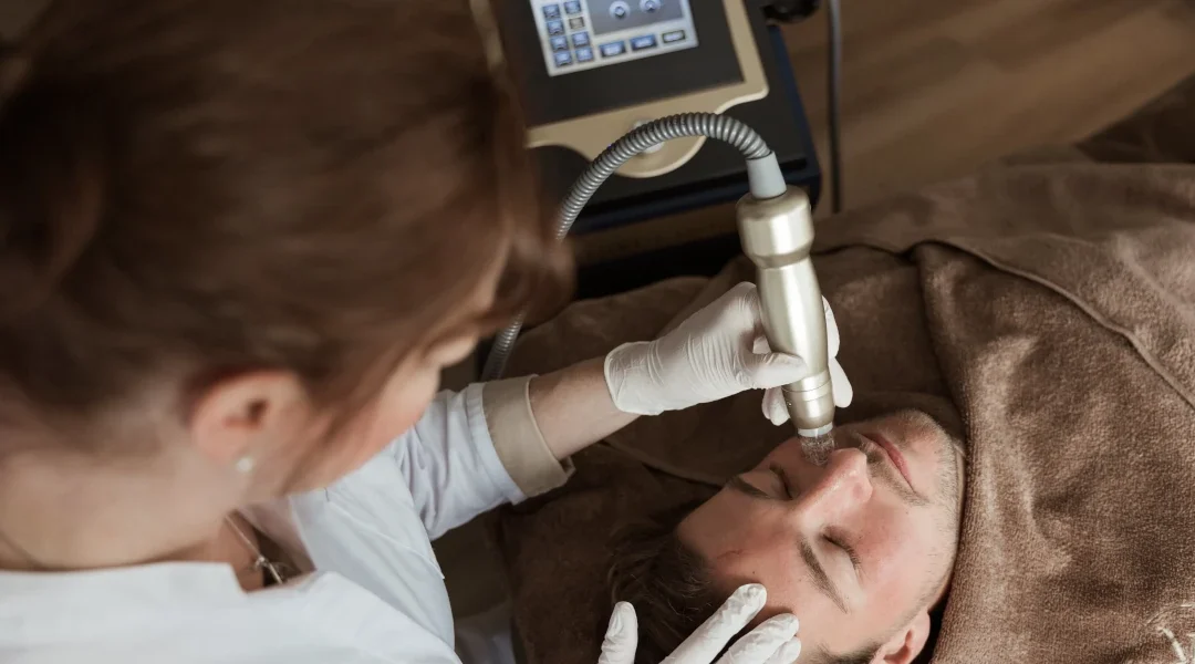 RF-microneedling behandeling